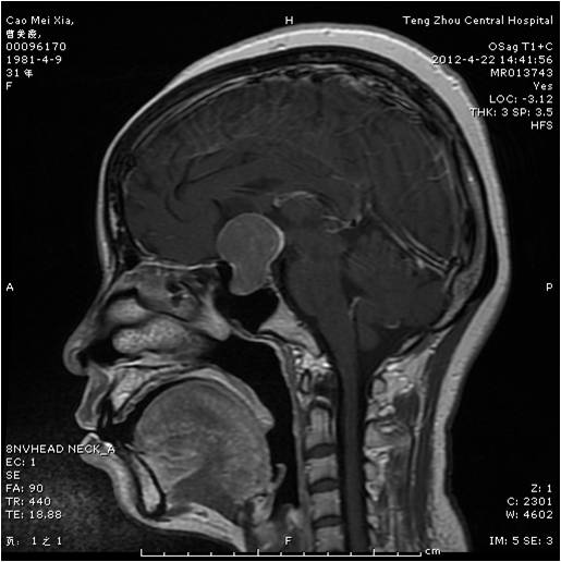 垂體瘤術(shù)前.jpg